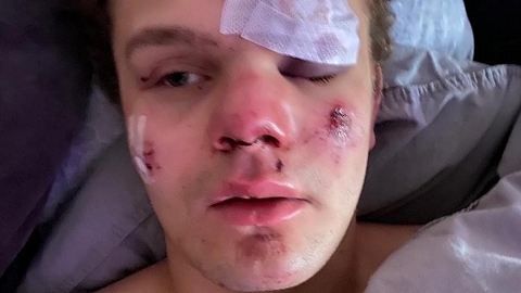 To personer er nu tiltalt efter et groft overfald på 19-årige Lauritz Lindboe Wind i Gothersgade i København tilbage i februar. (Privatfoto).
