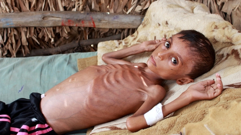 Billeder af udhungrede børn er ofte dukket op under den fem år lange krig i Yemen på Den Arabiske Halvø. Drengen er Hassan Merzam Muhammad, der 17. juli i år lå svært underernæret på en seng i familiens hus i provinsen Hajjah. Nu advarer FN om en mulig hungerkatastrofe.